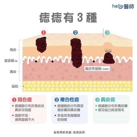 雞雞痣很多|痣變大、痣多或長毛會變皮膚癌？認識痣的形成與原因